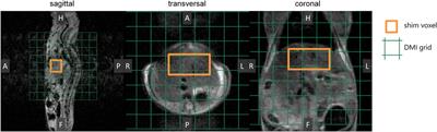 Glucose versus fructose metabolism in the liver measured with deuterium metabolic imaging